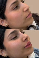 Rinolips – Armonización de Nariz y Labios con Ácido Hialurónico - Imagen 2
