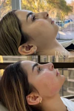 Mentomodelación y Contorno Mandibular con Ácido Hialurónico - Imagen 3