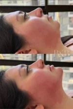 Mentomodelación y Contorno Mandibular con Ácido Hialurónico - Imagen 4