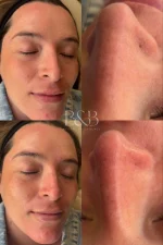 Hydrafacial® - Imagen 5