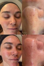 Hydrafacial® - Imagen 4