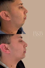 Mentomodelación y Contorno Mandibular con Ácido Hialurónico - Imagen 5