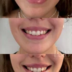 Toxina Botulínica para Sonrisa Gingival