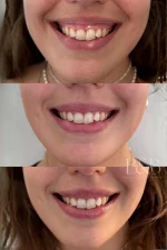 Toxina Botulínica para Sonrisa Gingival