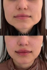 Toxina Botulínica para Bruxismo - Imagen 2