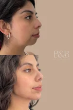 Armonización Facial - Plan personalizado según evaluación médica - Imagen 7