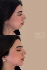 Armonización Facial - Plan personalizado según evaluación médica - Imagen 8