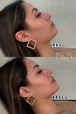 Rinolips – Armonización de Nariz y Labios con Ácido Hialurónico - Imagen 3