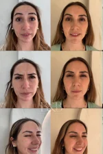 Toxina Botulínica (Botox) - Imagen 2