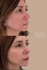 Radiofrecuencia Fraccionada  Endymed Pro Max – Intensif  Facial - Imagen 3
