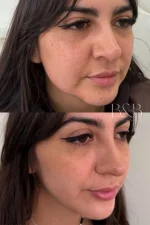 Radiofrecuencia Fraccionada  Endymed Pro Max – Intensif  Facial - Imagen 4