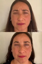 Toxina Botulínica (Botox) - Imagen 4