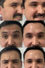 Toxina Botulínica (Botox) - Imagen 3