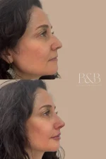 Rinolips – Armonización de Nariz y Labios con Ácido Hialurónico