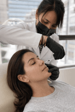 Relleno de Surcos Nasogenianos con Ácido Hialurónico