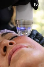 Radiofrecuencia Fraccionada  Endymed Pro Max – Intensif  Facial