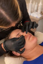 Hydrafacial® - Imagen 2