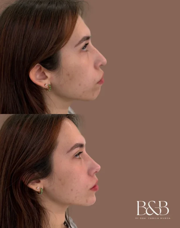 Comparativa de antes y después de Armonización facial entregada por Clínica B&B