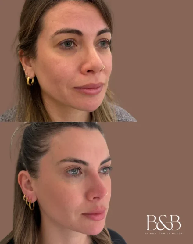 Comparativa de antes y después de Armonización facial entregada por Clínica B&B