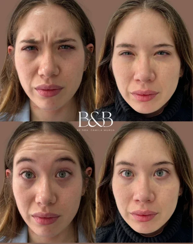 Comparativa de antes y después de Botox entregada por Clínica B&B